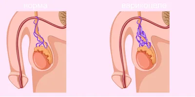 Золотой стандарт лечения варикоцеле в ЦНМТ в Новосибирске | ЦНМТ