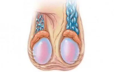 Варикоцеле у мужчин: лечение, степени, симптомы и причины