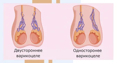 Варикоцеле у мужчин - причины, симптомы, диагностика и лечения в ИСЦ