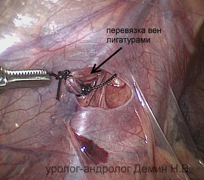 Лапароскопия варикоцеле у мальчиков, лечение, удаление у детей, цена  хирургической операции. | Москва