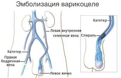 Варикоцеле у детей