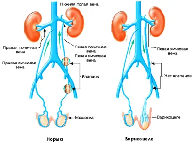Лапароскопия варикоцеле у мальчиков, лечение, удаление у детей, цена  хирургической операции. | Москва