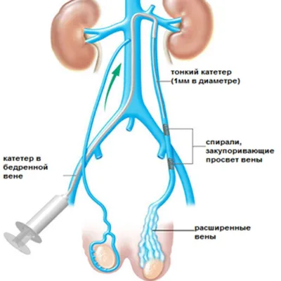 Варикоцеле у мужчин - Центр ЭКО
