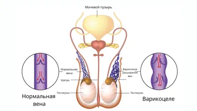 Варикоцеле у детей