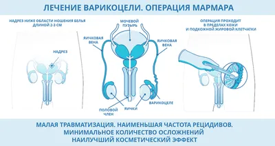 Варикоцеле фото