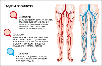 Варикозное расширение вен - симптомы, причины и лечение