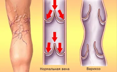 Варикозная болезнь нижних конечностей | Городская клиническая больница им.  Ф.И. Иноземцева