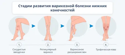 Варикозная болезнь: причины, симптомы, лечение и профилактика