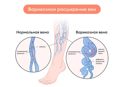 Ретикулярный варикоз и телеангиоэктазы