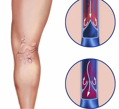 Почему при варикозе отсутствует отечность ног? Может ли быть варикоз без  отеков? | медицинские товары и медтехника в магазине Ортосалон