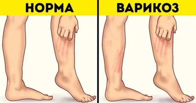 Диагностика и лечение варикозных сосудов нижних конечностей в Ташкенте