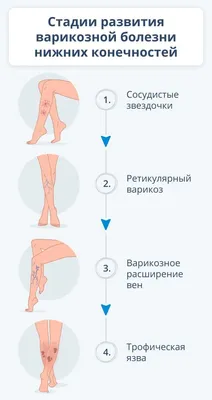 больные ноги с варикозным расширением вен PNG , нога, варикоз, вена PNG  картинки и пнг рисунок для бесплатной загрузки