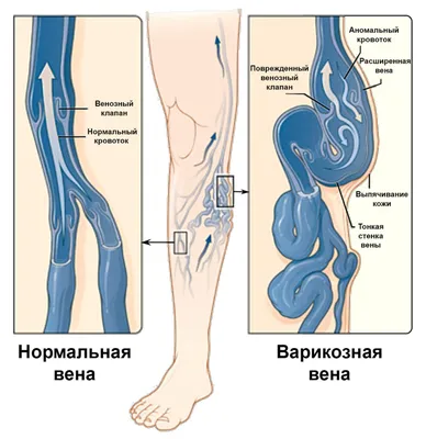 Варикозное расширение вен и тромбофлебит | Венолайф