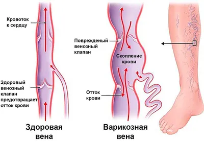 Жанайдар Казтуганов on Instagram: \"Расширение вен наружных половых органов  или вульварный варикоз является одним из симптомов варикозной болезни таза.  Как правило, это жалобы на наличие варикозно-расширенных вен на больших или  малых половых