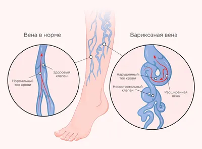 Варикоз - что это, симптомы заболевания, типы, диагностика и лечение