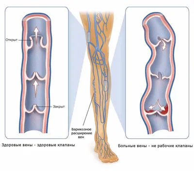 Варикозное расширение вен | Cayra Clinic