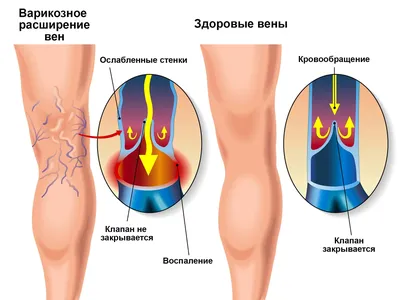 Может ли быть варикоз у мужчин? Подвержены ли варикозу мужчины? |  медицинские товары и медтехника в магазине Ортосалон