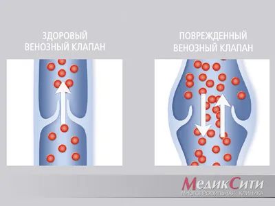 Варикозное расширение вен | Кейсы пациентов клиник Столица