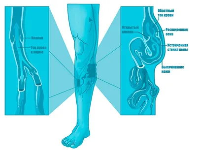 Варикоз вен на ногах: симптомы, причины, лечение, степени и признаки