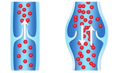 Почему при варикозе отсутствует отечность ног? Может ли быть варикоз без  отеков? | медицинские товары и медтехника в магазине Ортосалон