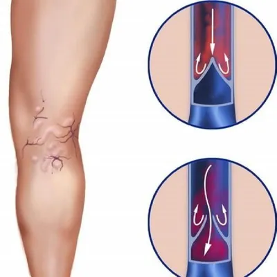 Варикоз - профилактика методы, питание, образ жизни