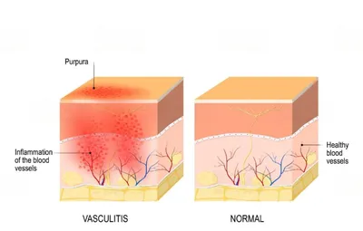 Что такое Васкулит (фото 1-8). Геморрагический васкулит кожи. Симптомы  васкулита на ногах - YouTube