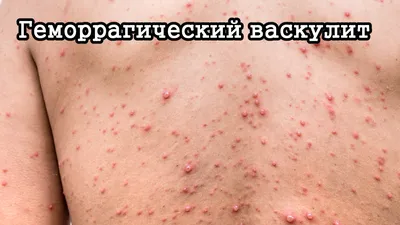 Геморрагический васкулит – что это за болезнь, 💉 лечение, симптомы и 🔬  диагностика на МЕД Zoon