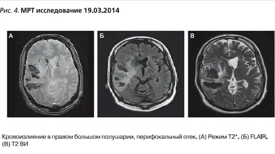 Что такое Васкулит (фото 1-8). Геморрагический васкулит кожи. Симптомы  васкулита на ногах | ТОП 100 ВРАЧЕЙ | Дзен