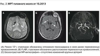 Геморрагический васкулит - причины, симптомы, лечение и диагностика  геморрагического васкулита в Москве