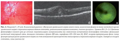 Первичный β-амилоид-ассоциированный васкулит центральной нервной системы /  Статья на сайте Волынской больницы от 16 марта 2015 г.