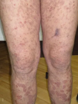 Heavy Legs Effective Varicose Veins Cream Spider Veins Treatment Vasculitis  | eBay