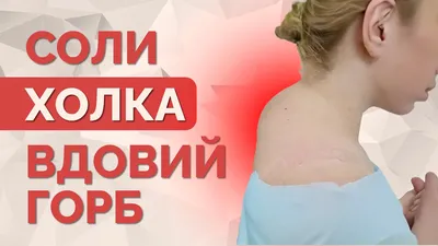 Сел на шею. Как избавиться от «вдовьего горба» | Здоровая жизнь | Здоровье  | Аргументы и Факты