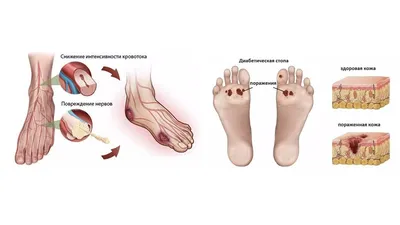 Диабетическая стопа: признаки и симптомы, как развивается, лечение синдрома  при сахарном диабете. Всё о стопе