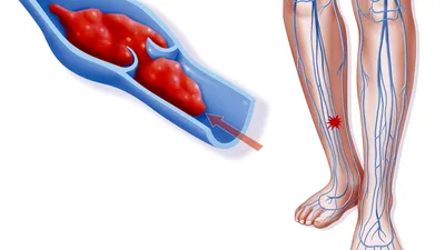 Тромбоз вен: причины и симптомы, лечение и диагностика, осложнения -  Клиника в Уручье