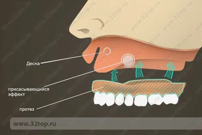 Съёмные БЕЗ нёба существуют? #стоматология #протезированиезубов - YouTube