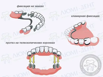 Зубные протезы - виды зубных протезов, бюгельный протез, квадротти,  акрифри, протезы на имплантах - YouTube