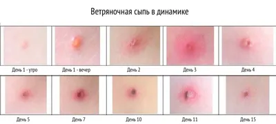 Ветрянка и краснуха у детей — симптомы и лечение