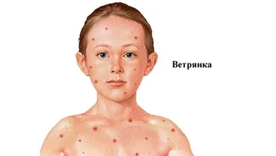 Ветрянка у детей: симптомы, лечение, фото, информация для родителей