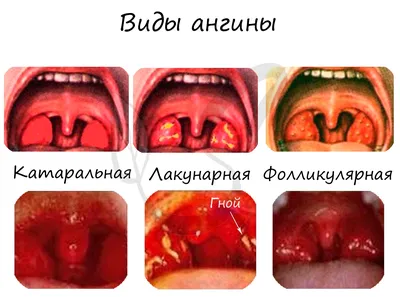 Ангина у взрослых: первые признаки и симптомы, как и чем лечить?