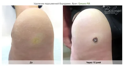 🔻Околоногтевая бородавка Один из... - LV_doctor_cosmetology | Facebook