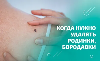 Удаление подошвенной бородавки - Клиника «ЛИЦ» — современный медицинский  центр в СПб
