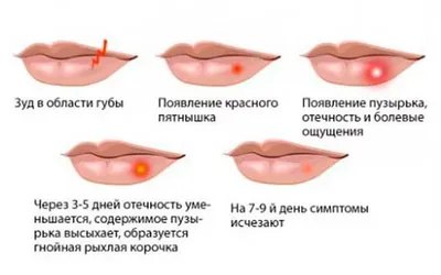 Что такое герпес? - Medikana