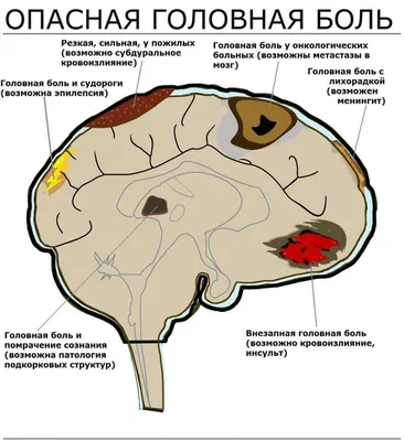 ДОХОДЪ on X: \"Типы головной боли. via @safalniveshak  https://t.co/1OZBBc7Dgm\" / X