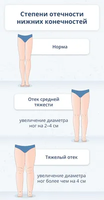 Отеки ног: что делать и почему отекают ноги у женщин и мужчин?