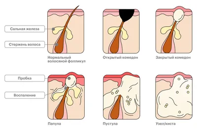 виды прыщей, png | PNGWing