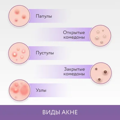 Прыщи на лице: причины и лечение