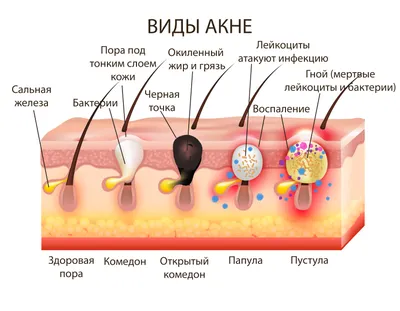 Типы воспаления кожи акне Прыщи, чиреи, уайтхед, закрытые угри, папулы,  Pustules кистозное акне. Иллюстрация вектора - иллюстрации насчитывающей  цыпк, прыщ: 167365173