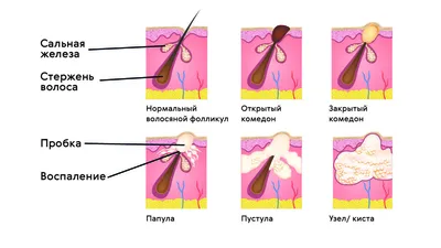 Последствия несвоевременного лечения акне