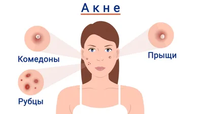 Виды прыщей и как с ними бороться | IMAGE Skincare | Дзен