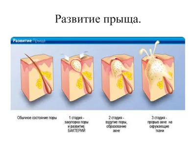 типы прыщей иллюстрация вектора. иллюстрации насчитывающей воспаление -  243981475